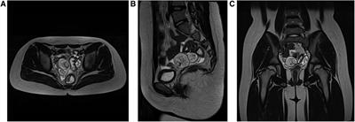 Ensuring safety and feasibility for resection of pediatric benign ovarian tumors by single-port robot-assisted laparoscopic surgery using the da Vinci Xi system